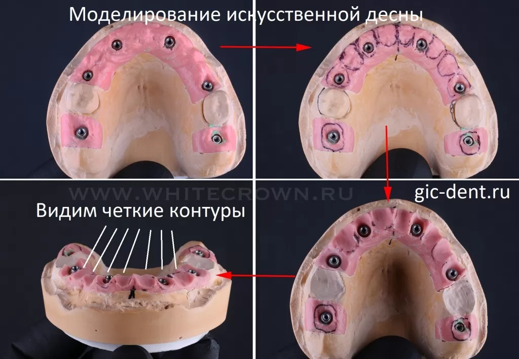 Лабораторное моделирование искусственной десны на верхней челюсти. Автор - ортопед НИЦ Карнеев Андрей Николаевич